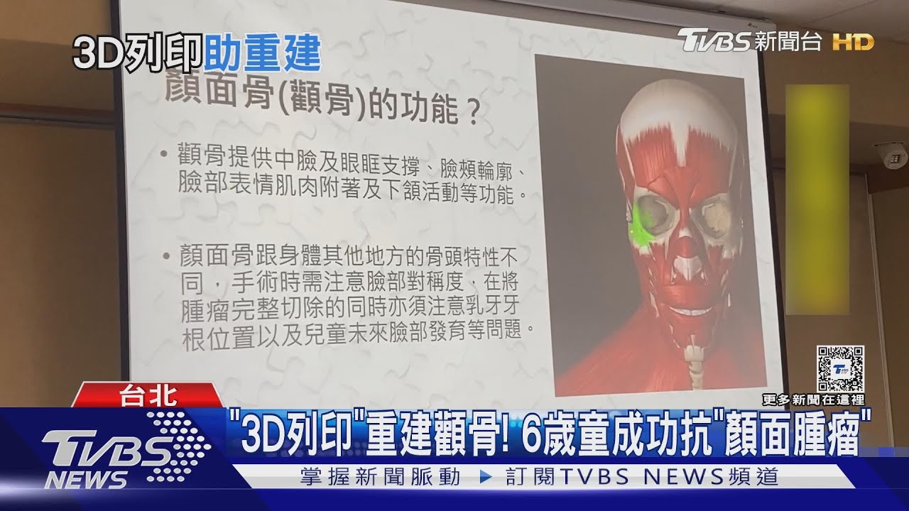 「3D列印」重建顴骨! 6歲童成功抗「顏面腫瘤」