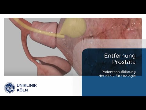 Prostatakrebs | Entfernung der Prostata (Klinik für Urologie Patienteninformation) | Uniklinik Köln.