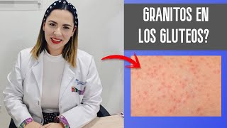 CÓMO TRATAR LA FOLICULITIS - GRANITOS EN LOS GLÚTEOS  ✅✅