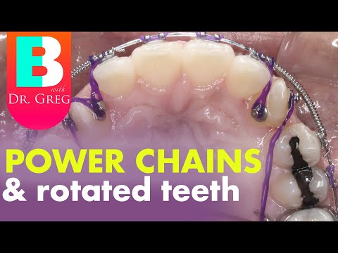 Braces Power Chain to Rotate Canine Teeth