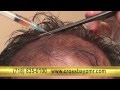 Hair Loss Treatment - Platelet Rich Plasma (PRP ...