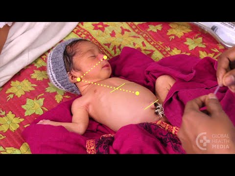 Inserting a Nasogastric Tube - Video - Global Health Media Project