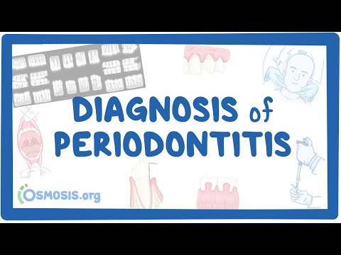 Diagnosis of Periodontitis
