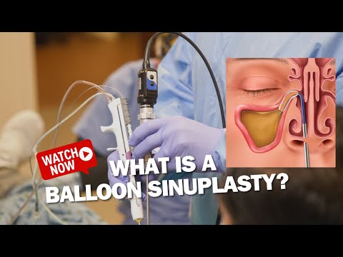 What is a Balloon SInuplasty?