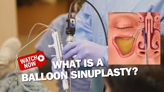 What is a Balloon SInuplasty?