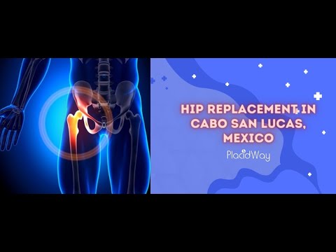 Hip Replacement in Cabo San Lucas, Mexico