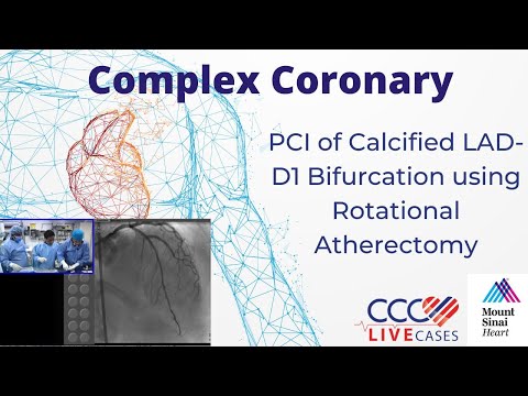 PCI of Calcified LAD-D1 Bifurcation using Rotational Atherectomy - CCC Live Cases Aug 2016