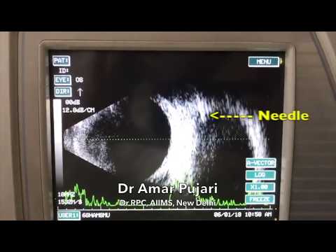 Continuous B-Scan Ultrasound For Orbital Hematoma Damage