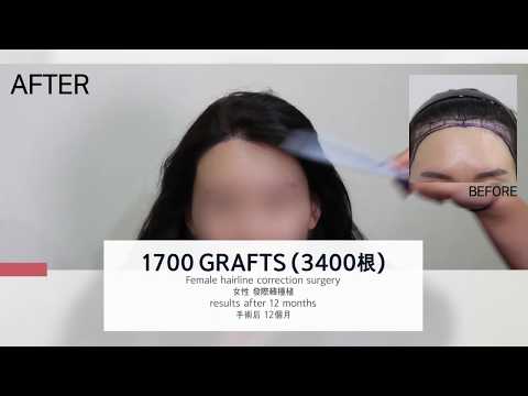 Female hairline correction surgery results after 12months - 뉴헤어 I 모발이식 I Before&After I
