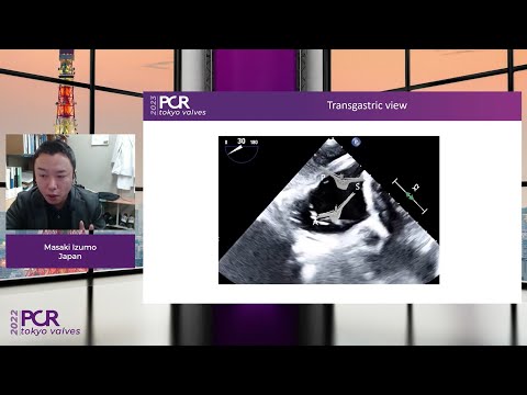 The tricuspid valve: from diagnosis to repair. An Asian perspective - Webinar