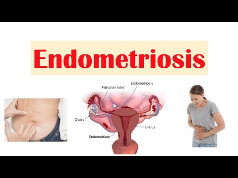 Pre Eclampsia Symptoms Pathophysiology and Treatment