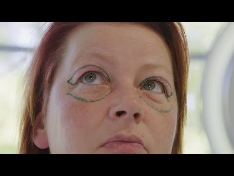 Lidstraffung OP - Meine Oberlidstraffung OP