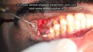 preview picture of video 'Infected periodical abscess teeth Extraction and Immediate Implant in INDIA'
