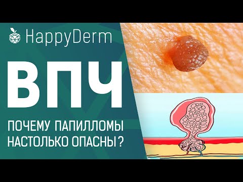 ВПЧ! Причины и лечение. Насколько опасен вирус папилломы человека и как удалить папилломы в Минске