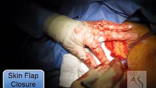 HS armpits surgery