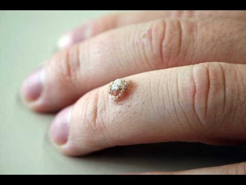 Эффективный недорогой отбеливающий крем для лица Дерматоз пигментного пятна