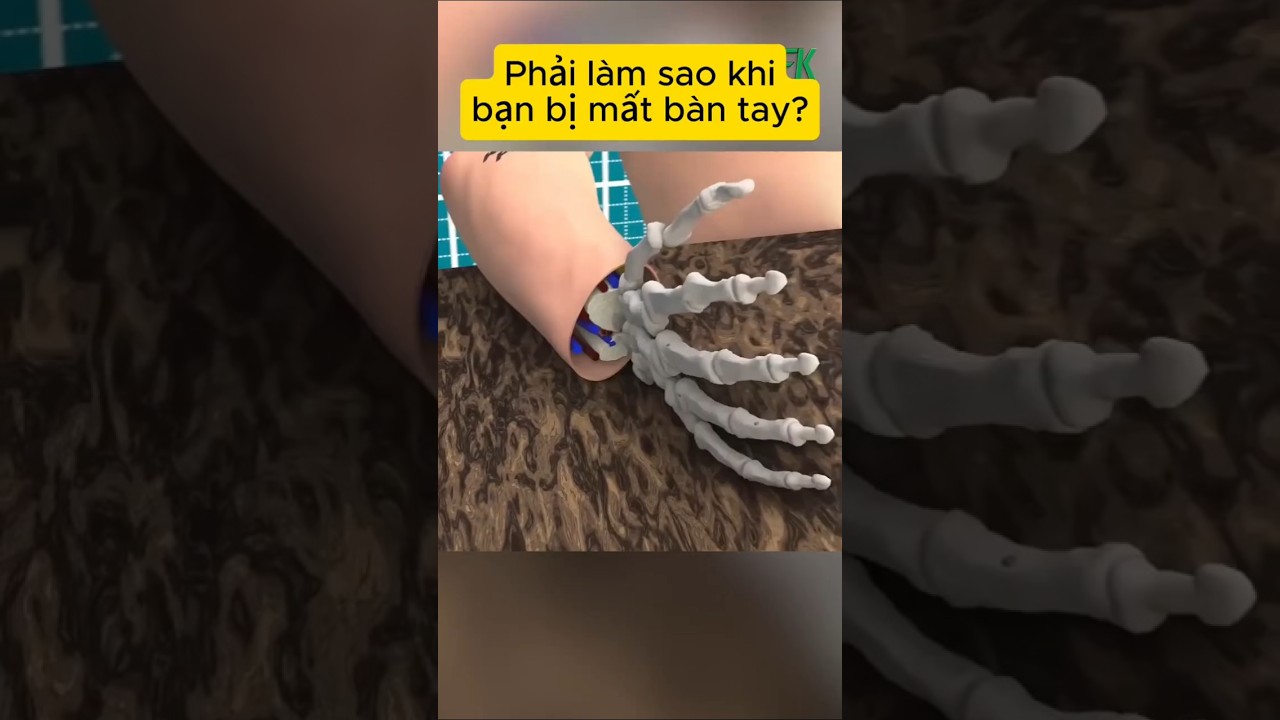 Phải làm sao khi bạn bị mất một bàn tay?