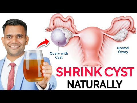 Just 1 Glass Daily To Shrink Cyst Naturally - Dr. Vivek Joshi 