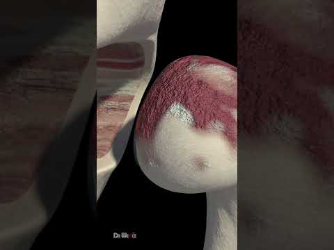 Hip Replacement Explained