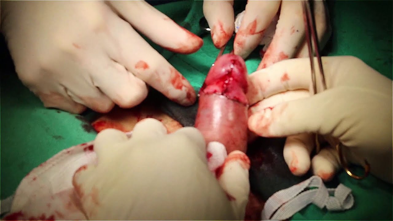 Postectomia  (fimose) / Postectomy (phimosis)