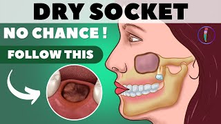 Tooth extraction aftercare I Wisdom tooth extraction - Tips for faster healing & prevent dry socket