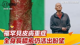 罹罕見皮膚重症！全身長膿疱還得勇敢活下去