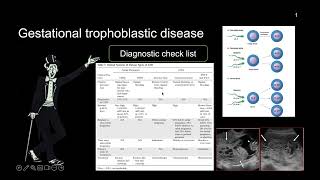 2-Gestational trophoblastic disease