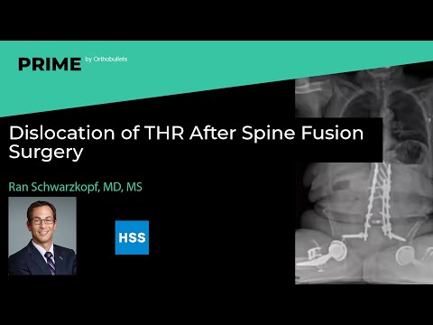 Dislocation of THR After Spine Fusion Surgery - Ran Schwarzkopf, MD, MS