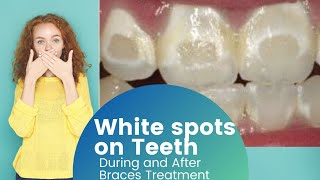White Spots on Teeth after Braces Treatment.