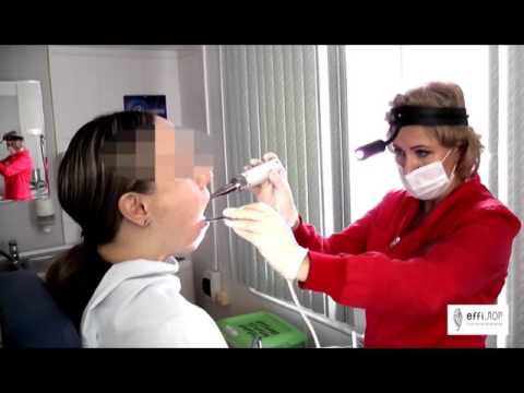 фонофорез миндалин