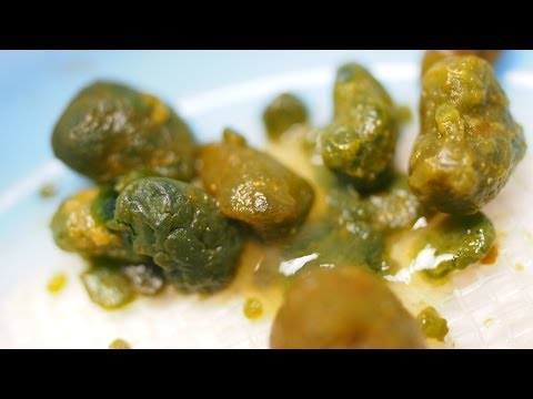 Welche Medikamente von Prostatitis nehmen Fokale Fibrose der Prostata, die ist