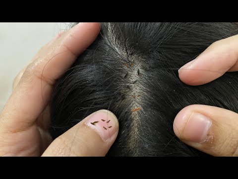 Remove lice from brown hair part4 #asmr #lice #haircare #piojos #kututv #cleanhair