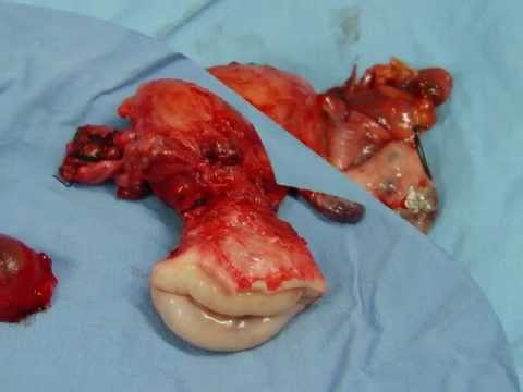 Histerectomia realizada por displasia de alto grado por virus del papiloma humano