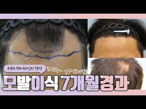 30대 후반 남성,절개,3800모,M자 모발이식 7개월 경과영상!