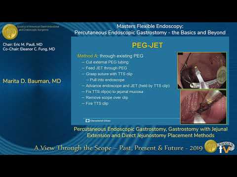 Percutaneous Endoscopic Gastrostomy, Gastrostomy with Jejunal Extension...