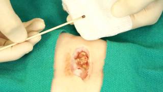 Chemical Cauterization- Understand Wound Care