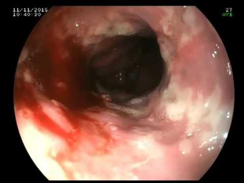 HSV Oesophagitis