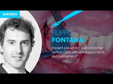 Implant placement and horizontal/vertical GBR with autologous bone and permamem®