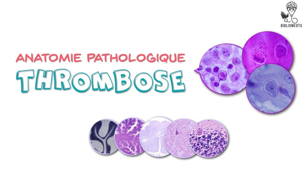Anatomie Pathologique - Thrombose