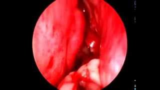 Cirugia endoscopica de la poliposis nasosinusal