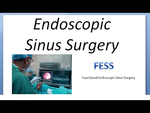 ENT FESS Functional Endoscopic Sinus Surgery Types Indications Uses