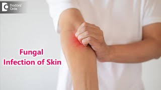 Skin Mycosis: Symptoms, Causes & Treatment | Fungal Infection - Dr. Rajdeep Mysore | Doctors