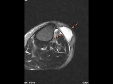 Tibialis anterior muscle tear and leg compartment anatomy