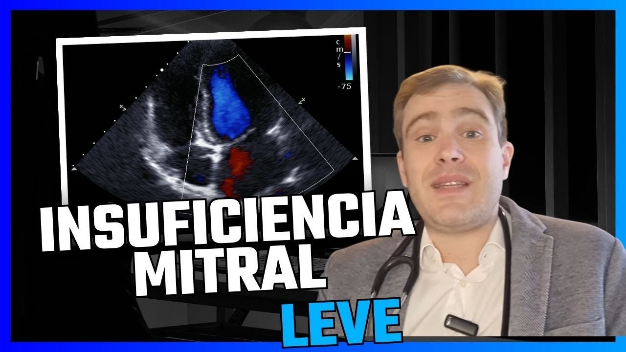 Insuficiência Mitral Leve: o que você deve pensar quando vê esse resultado no ecocardio.