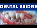 Dental Bridge Fixed Dental Replacement