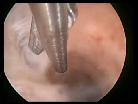 Asherman nice by my student, Osama Shawki world of Hysteroscopy