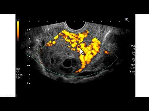 Ultrassonografia na mola invasora