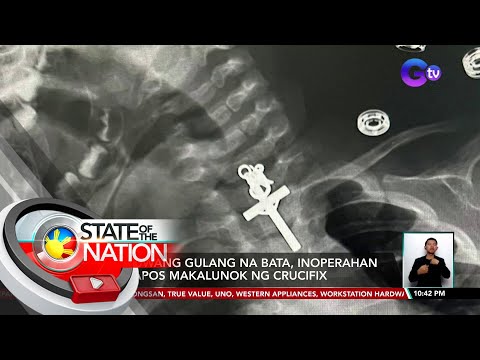 10 buwang gulang na bata, inoperahan matapos makalunok ng crucifix SONA