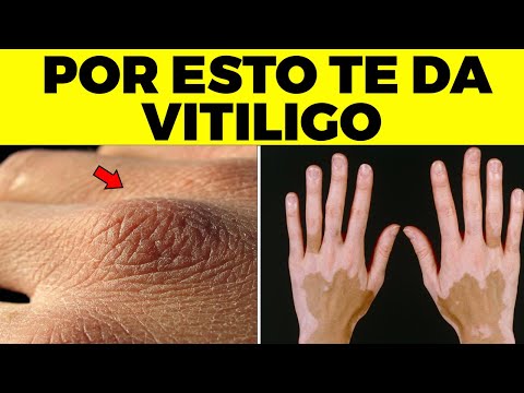 Conoce Las Principales Causas y Tratamientos Del Vitiligo