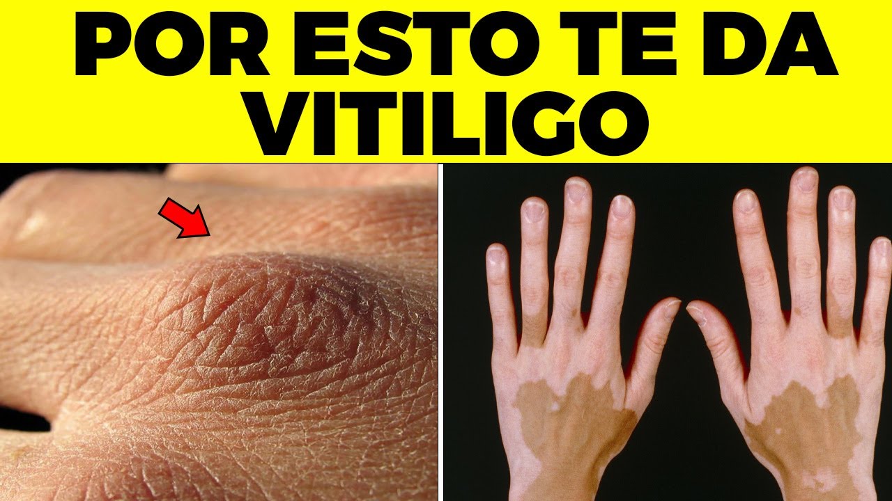 ¡ALERTA! Por Esta Razón Te Da Vitiligo, Esto Afecta A Tu Piel Y nadie te lo dice
